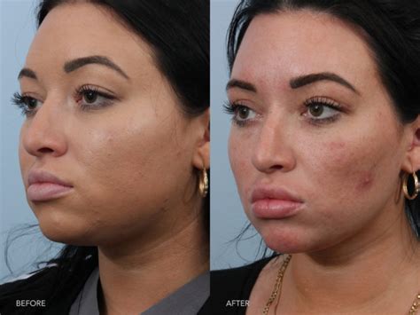 Can Buccal Fat Removal Be Reversed? Exploring the Myths and Realities of Facial Contouring